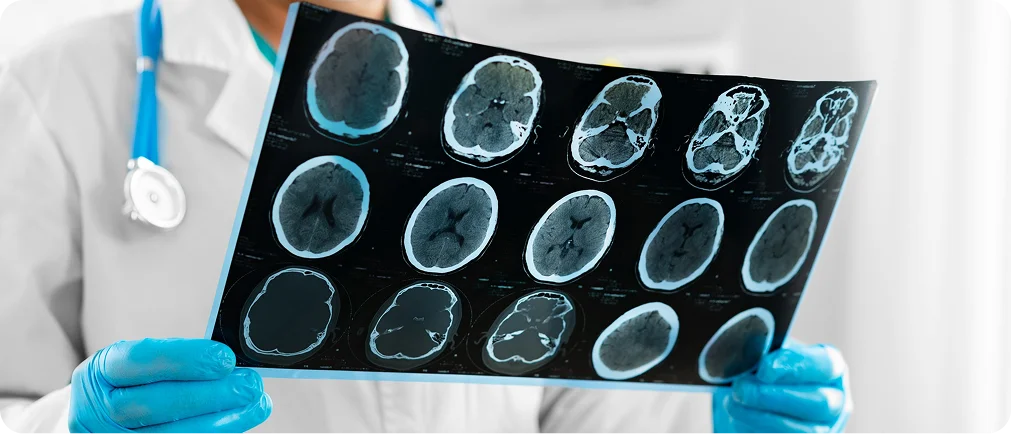 Brain Stroke 4 image 2