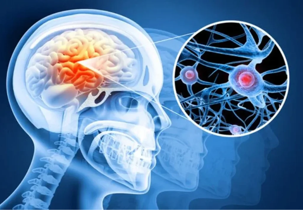 Epilepsy Treatment in Delhi by Dr. Shishir Pandey 10 image 6