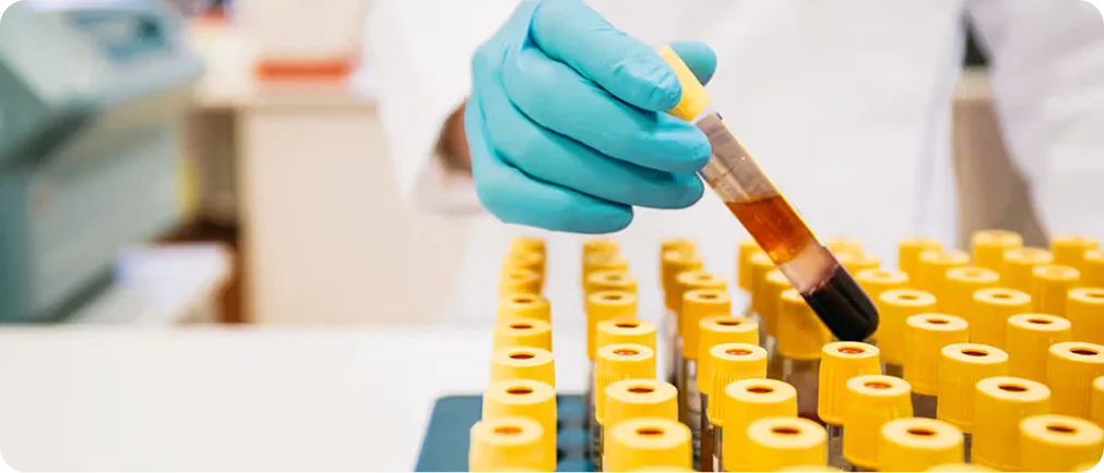 blood test brain stroke treatment delhi.webp