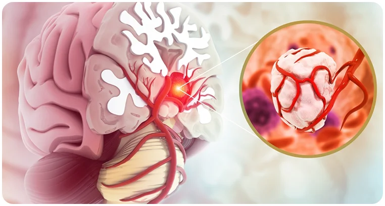 brain tumor linked to seizure symptoms