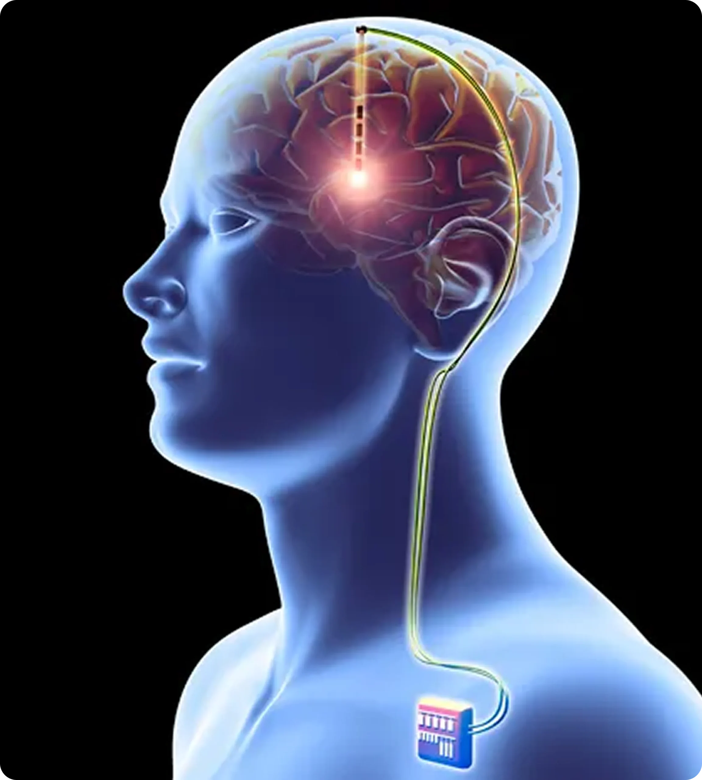parkinsons disease treatment deep brain stimulation